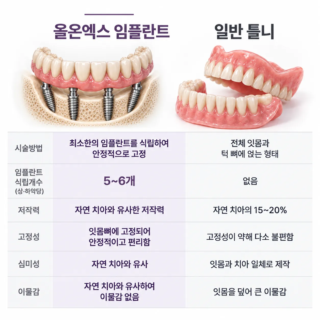올온엑스 임플란트와 일반 틀니 비교표. 시술 방법, 임플란트 식립 개수, 저작력, 고정성, 심미성, 이물감.