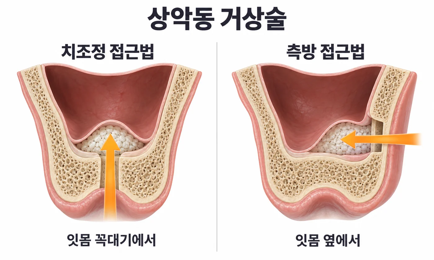 상악동 거상술. 치조정 접근법: 잇몸 꼭대기에서 상악동 바닥을 들어 올려 채움. 측방 접근법: 잇몸 옆으로 창을 내어 채움.