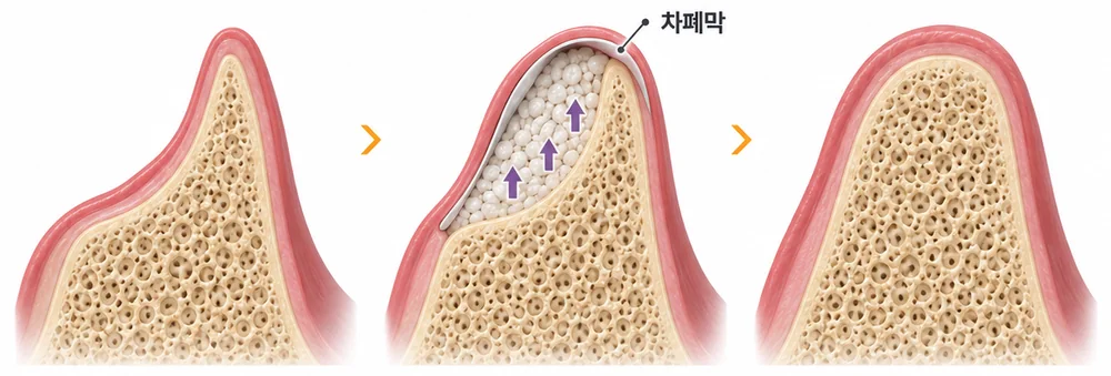 골유도재생술