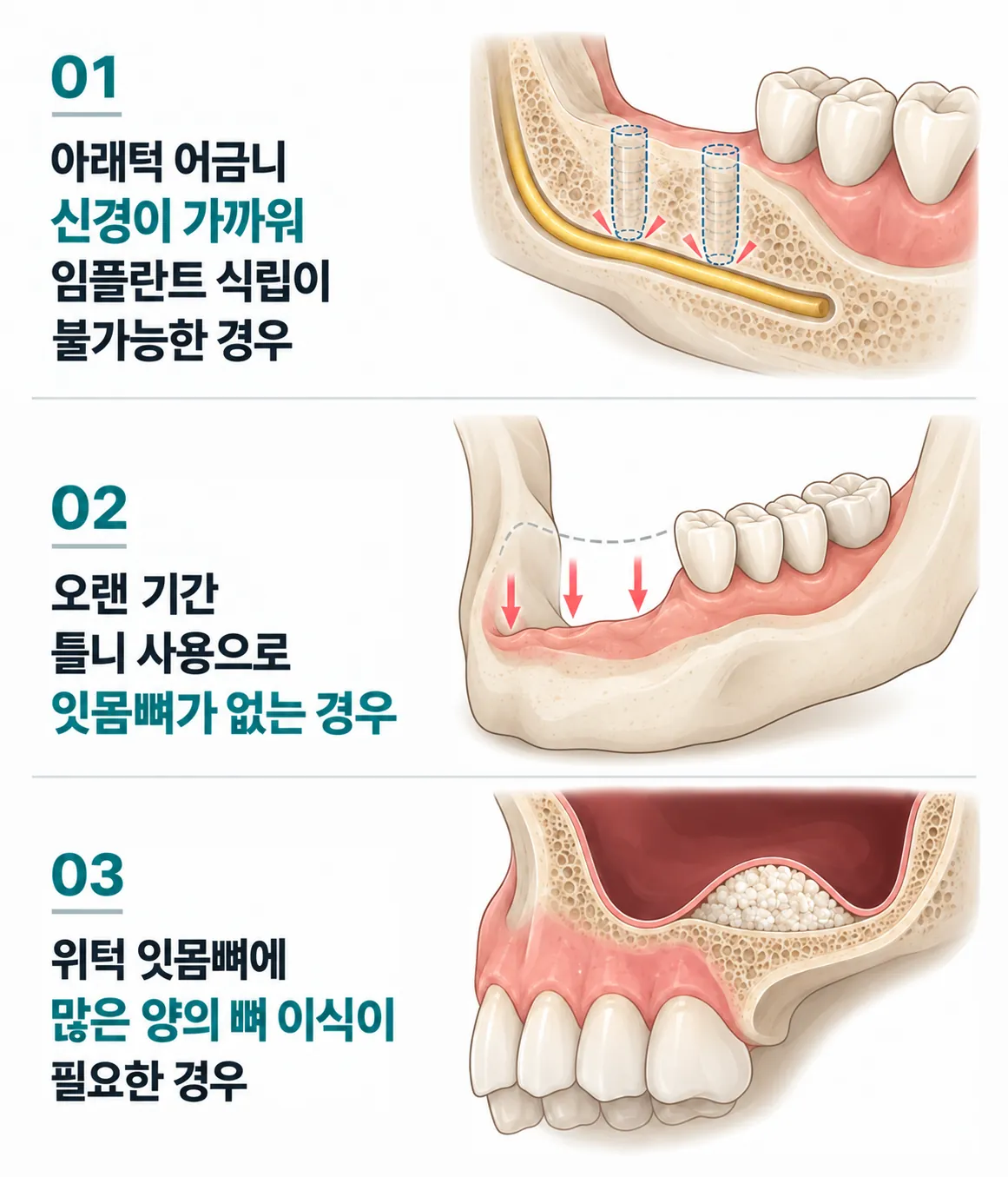 올온엑스가 필요한 경우 세 가지. 01 아래턱 어금니 신경이 가까워 임플란트 식립이 불가능한 경우. 02 오랜 기간 틀니 사용으로 잇몸뼈가 없는 경우. 03 위턱 잇몸뼈에 많은 양의 뼈 이식이 필요한 경우.